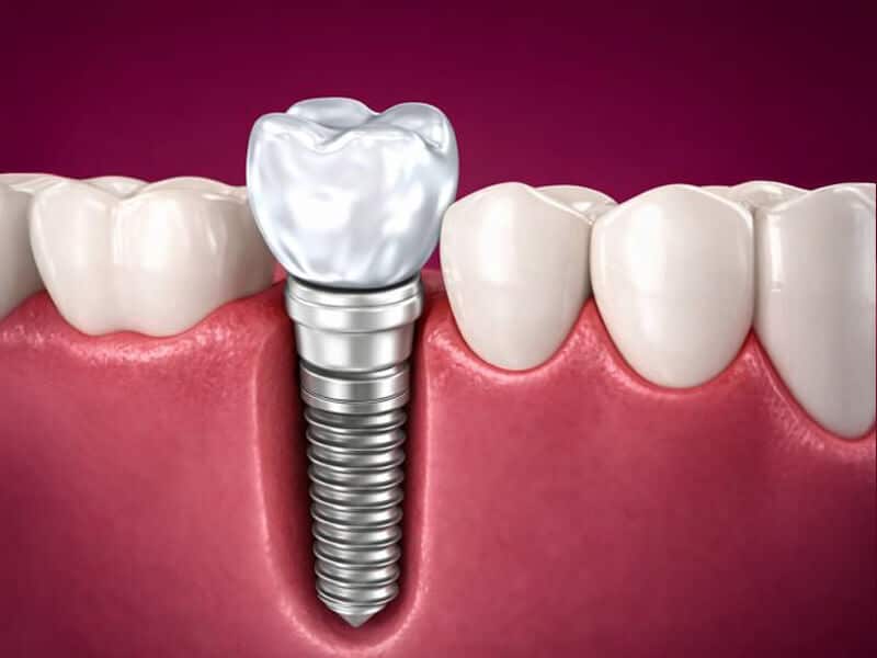 Dental implant illustration showing tooth replacement treatment